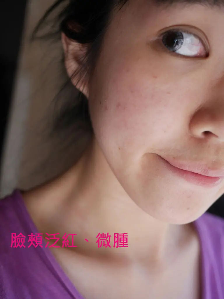 3D聚左旋乳酸術後紅腫大約五天退掉