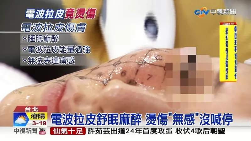 醫師的技術與經驗才是FLX鳳凰電波拉皮治療的關鍵