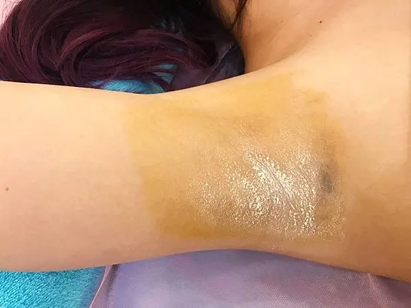 Miradry腋淨爽術後出汗改善