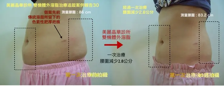 雙機體外溶脂追蹤案例報告30