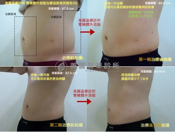 雙機體外溶脂追蹤案例報告12