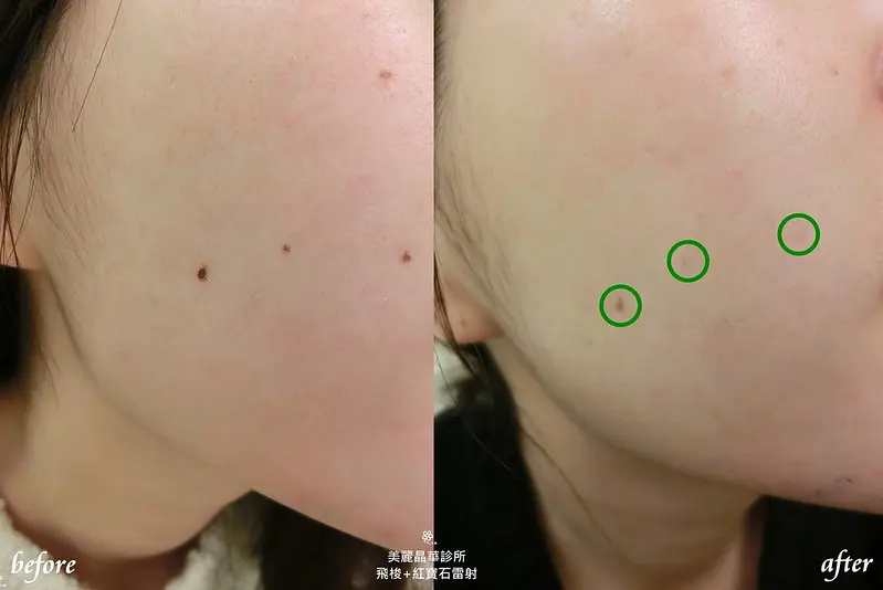 紅寶石雷射術後
