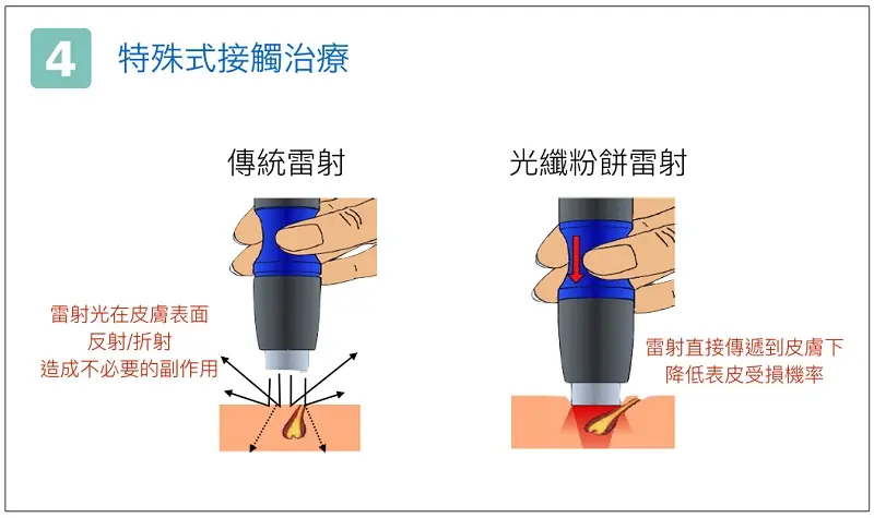 光纖粉餅雷射特殊式接觸治療