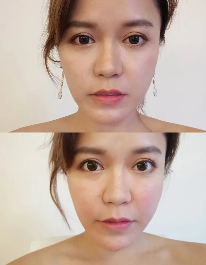 玻尿酸八點拉提術前術後差異比對