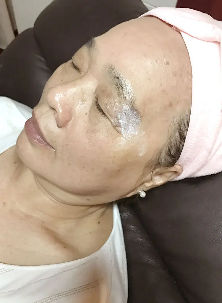 紅寶石除斑雷射術後