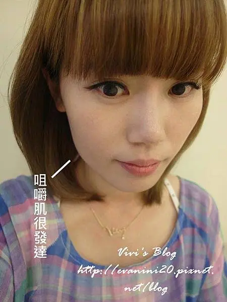 肉毒咬肌治療前
