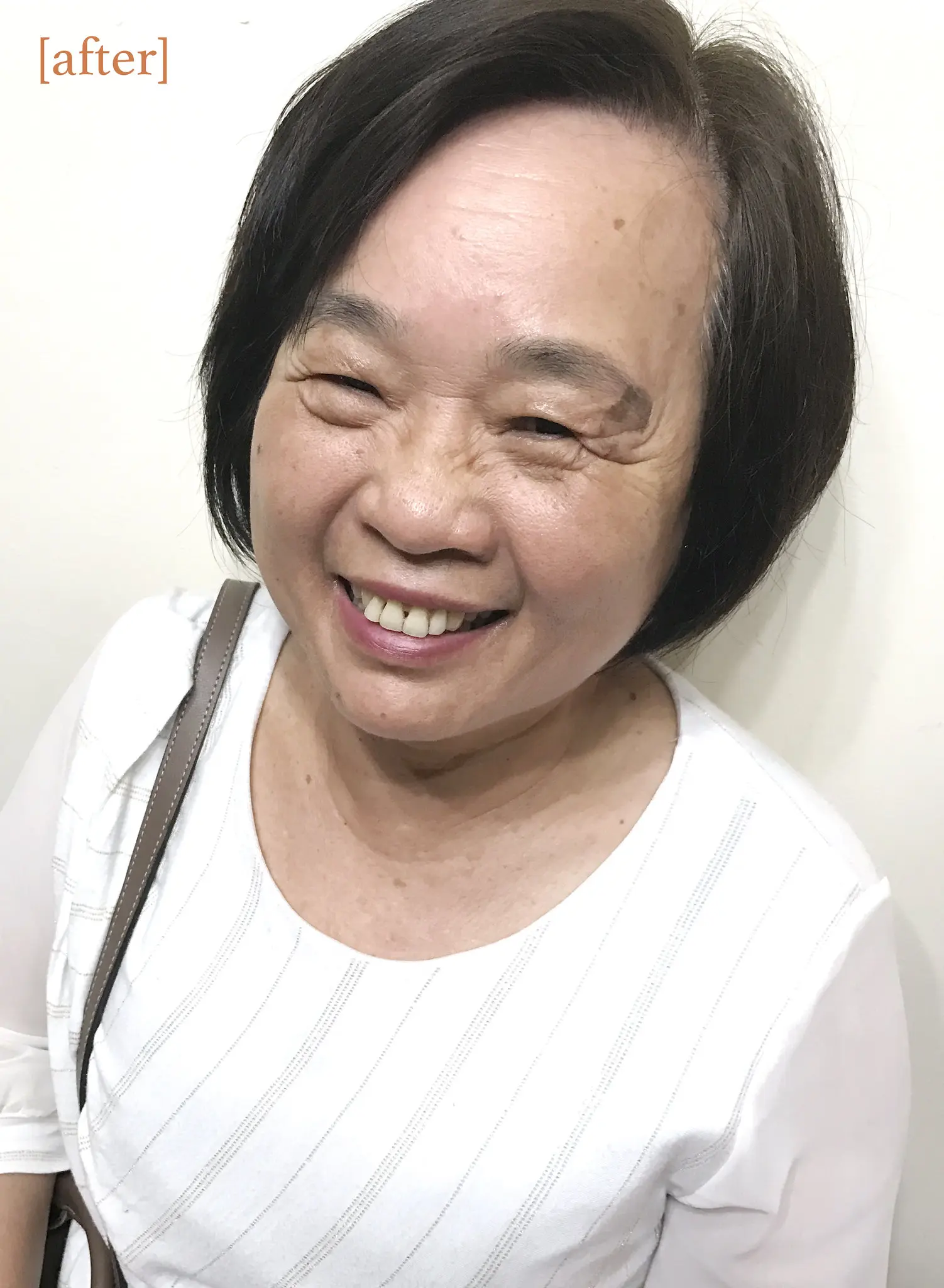 維納斯電波拉皮+紅寶石除斑雷射術後