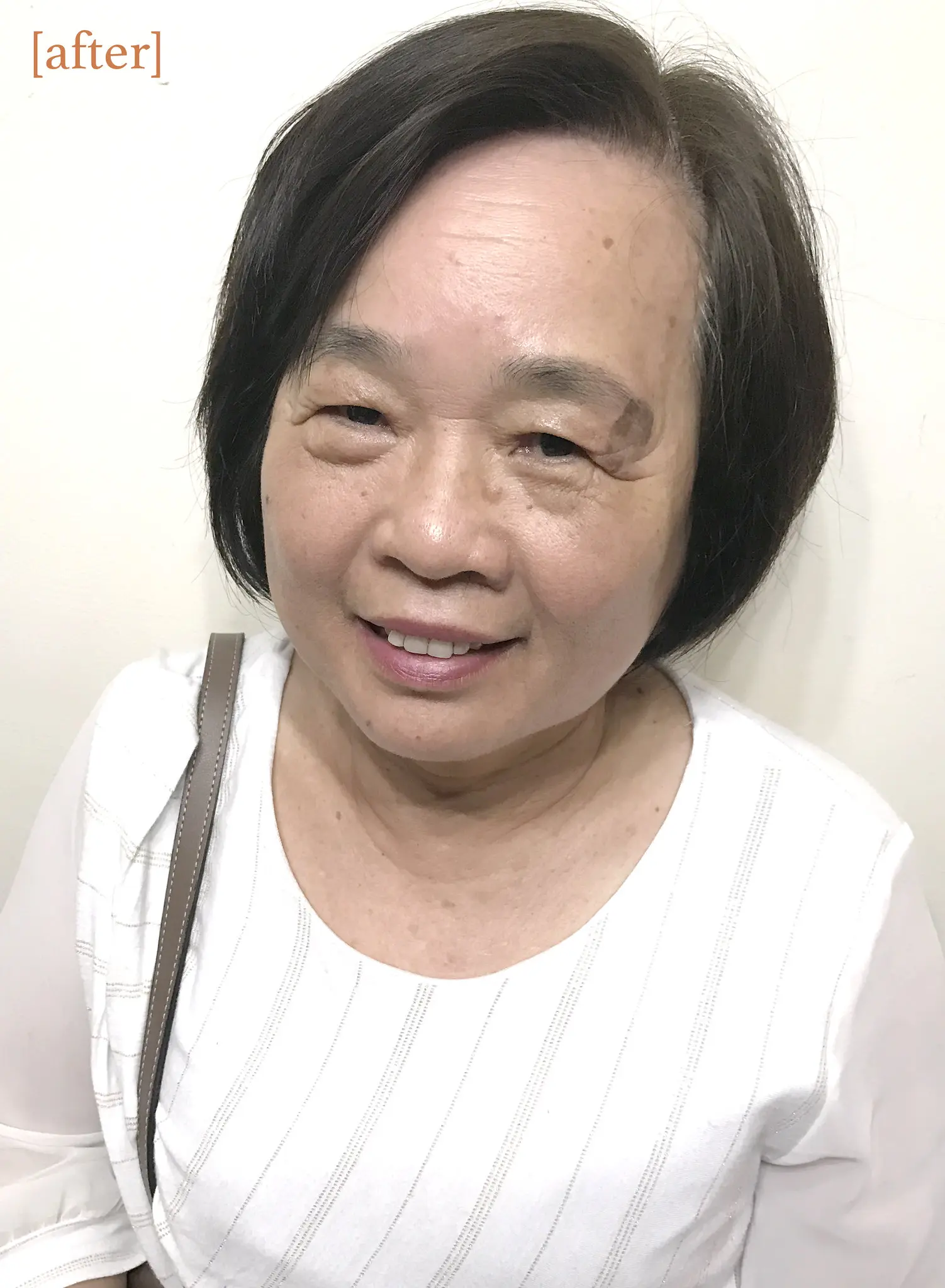 維納斯電波拉皮+紅寶石除斑雷射術後