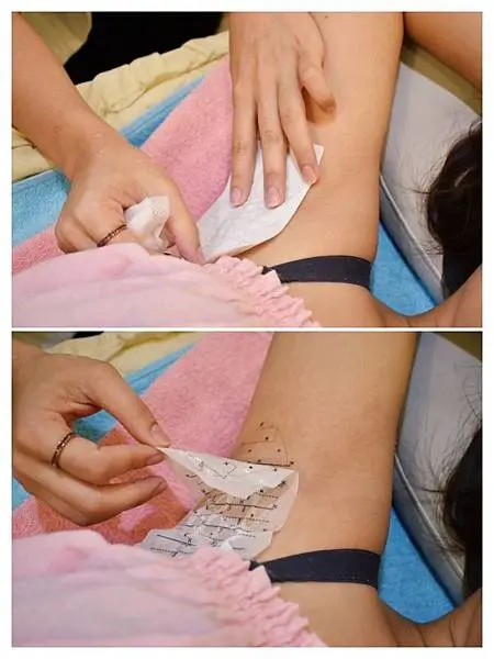 Miradry腋淨爽術前標記治療位置