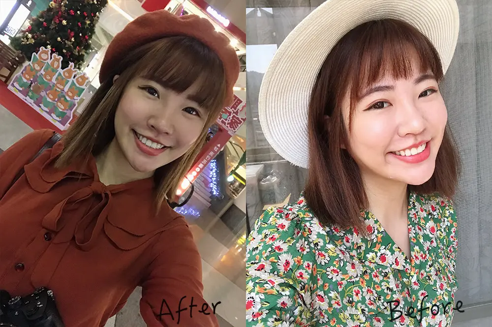 玻尿酸法令紋淚溝術前術後差異比較