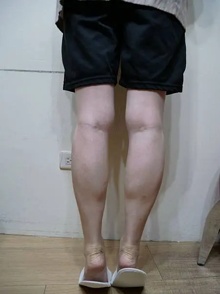 肉毒小腿術前