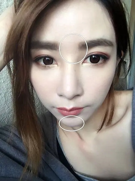玻尿酸下巴術後下巴變瘦變尖