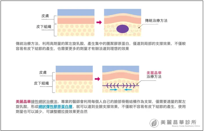 3D聚左旋乳酸線性網狀治療法