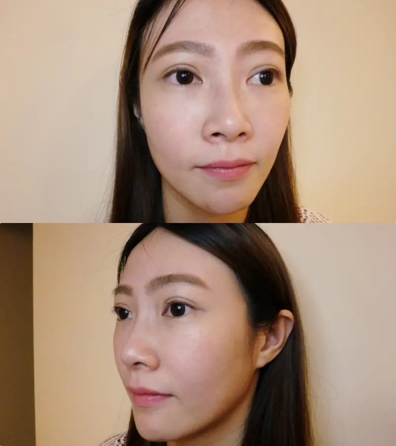 極線音波拉皮術前