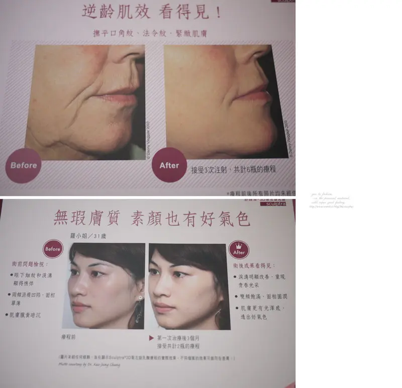 3D聚左旋乳酸術前術後差異比較案例