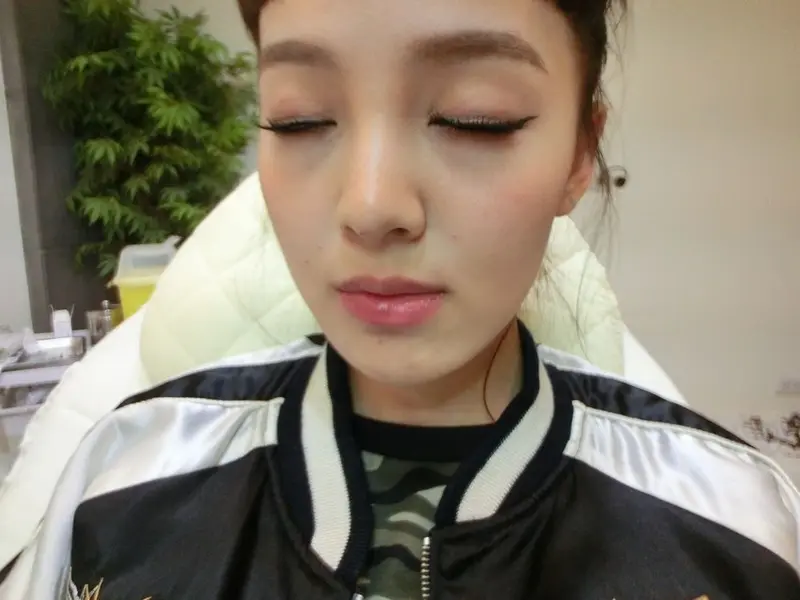 玻尿酸下巴治療前