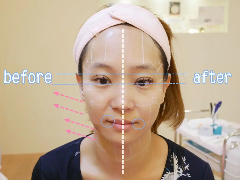 ulthera極線音波拉皮術前術後差異比較