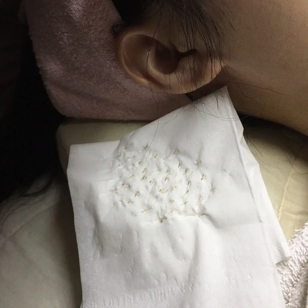 水涵氧換膚所清理出的粉刺