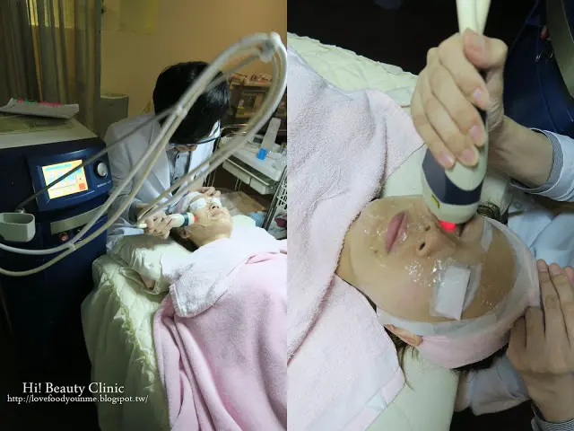 蔡之棟醫師光纖粉餅雷射治療過程