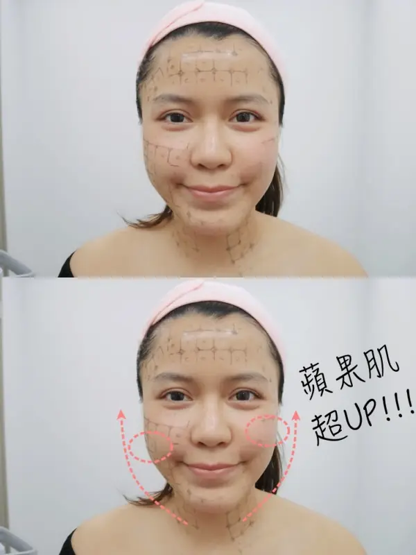 FLX鳳凰電波治療半邊臉蘋果肌超UP