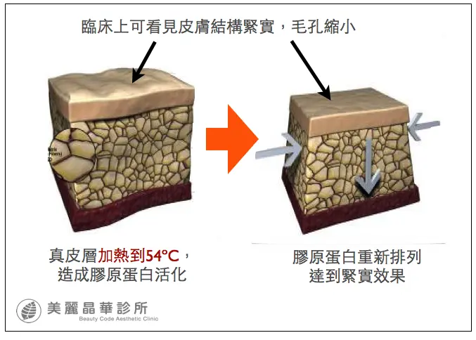 光纖粉餅雷射治療後皮膚結構緊實毛孔縮小