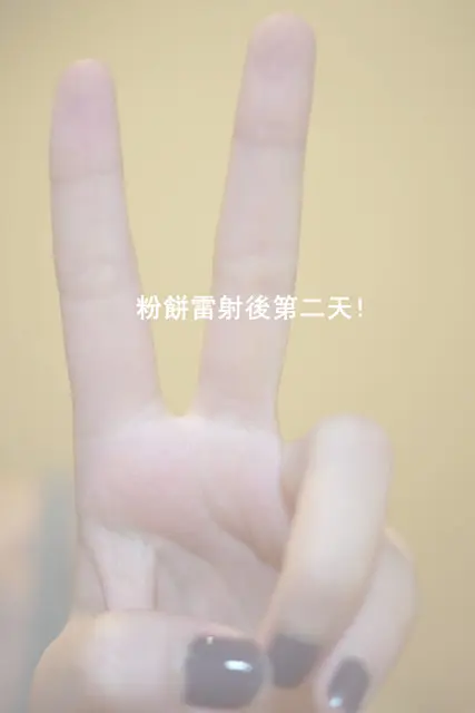 光纖粉餅雷射