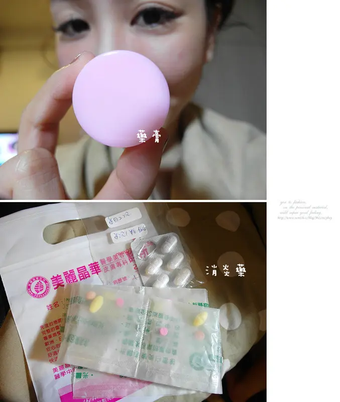 3D聚左旋乳酸術後藥膏與消炎藥