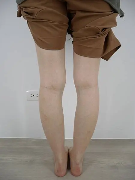 肉毒瘦小腿