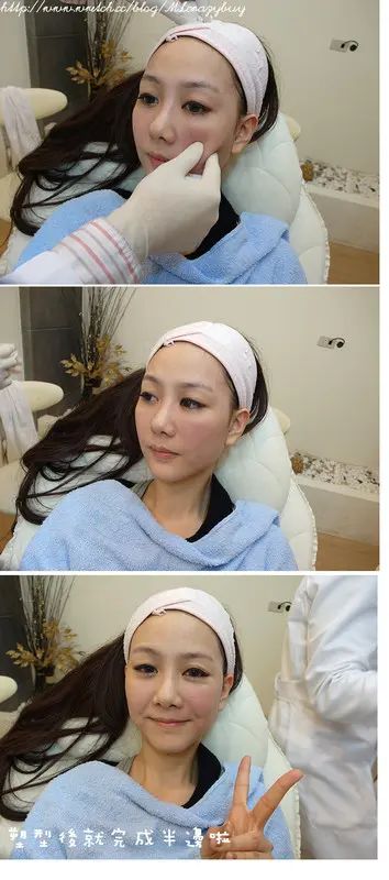 3D聚左旋乳酸治療半邊臉後塑型