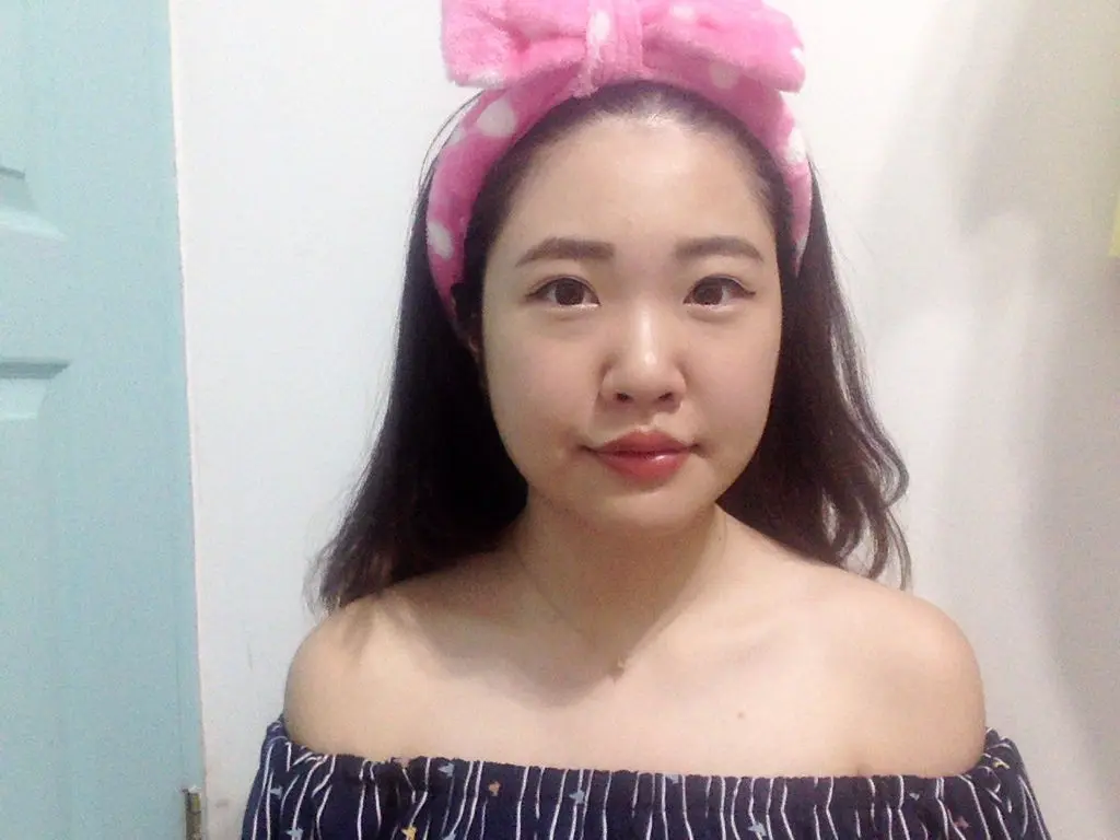 肉毒瘦小臉術後
