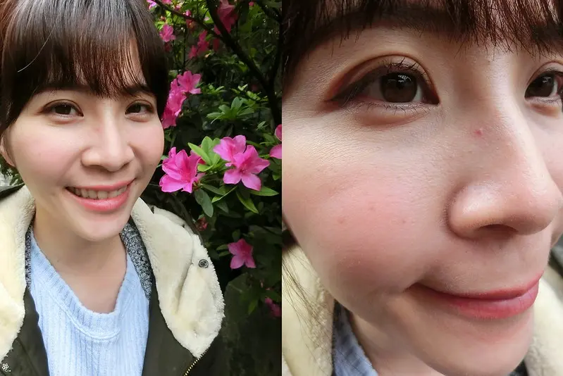 紅寶石雷射與飛梭雷射術後第十八天