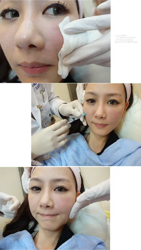 3D聚左旋乳酸治療過程