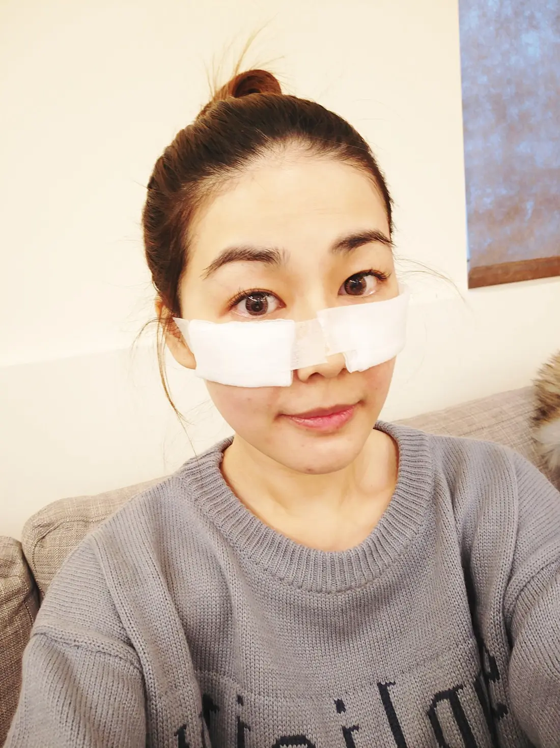 玻尿酸淚溝術後濕敷