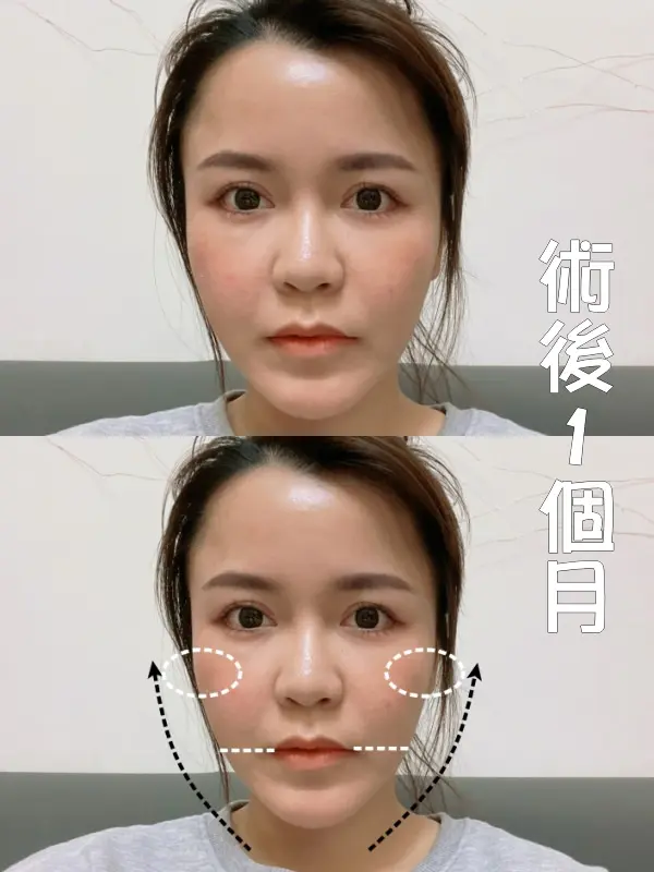 FLX鳳凰電波術後一個月