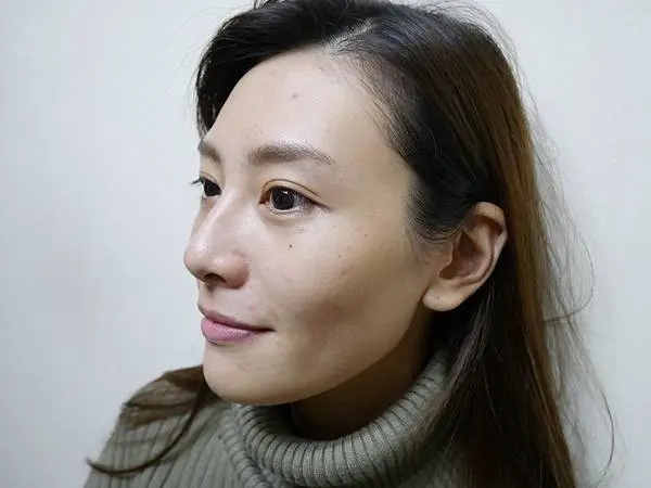 光纖粉餅雷射術前