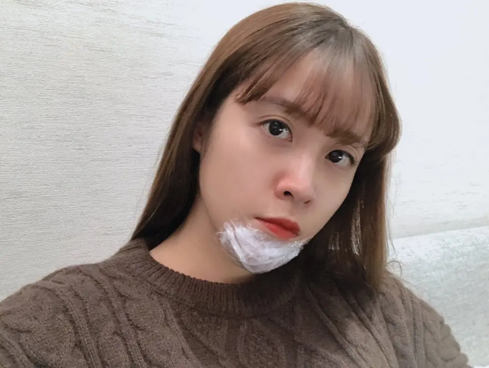 玻尿酸下巴術前敷麻藥