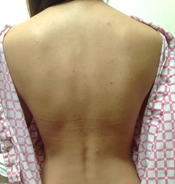 杏仁酸美背