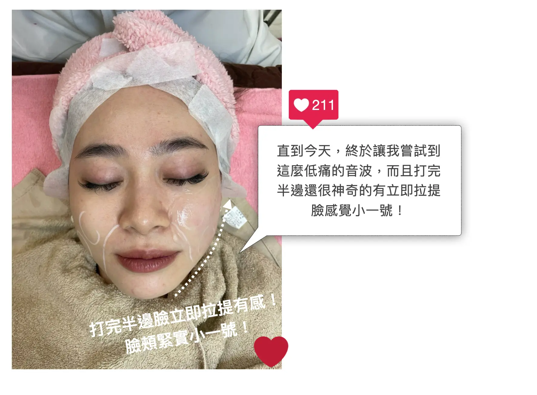 渦旋音波打完半邊臉立即拉提有感，臉頰緊實小一號