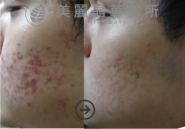 德國光纖粉餅雷射經五次治療改善痘疤及膚質