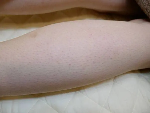 肉毒瘦小腿