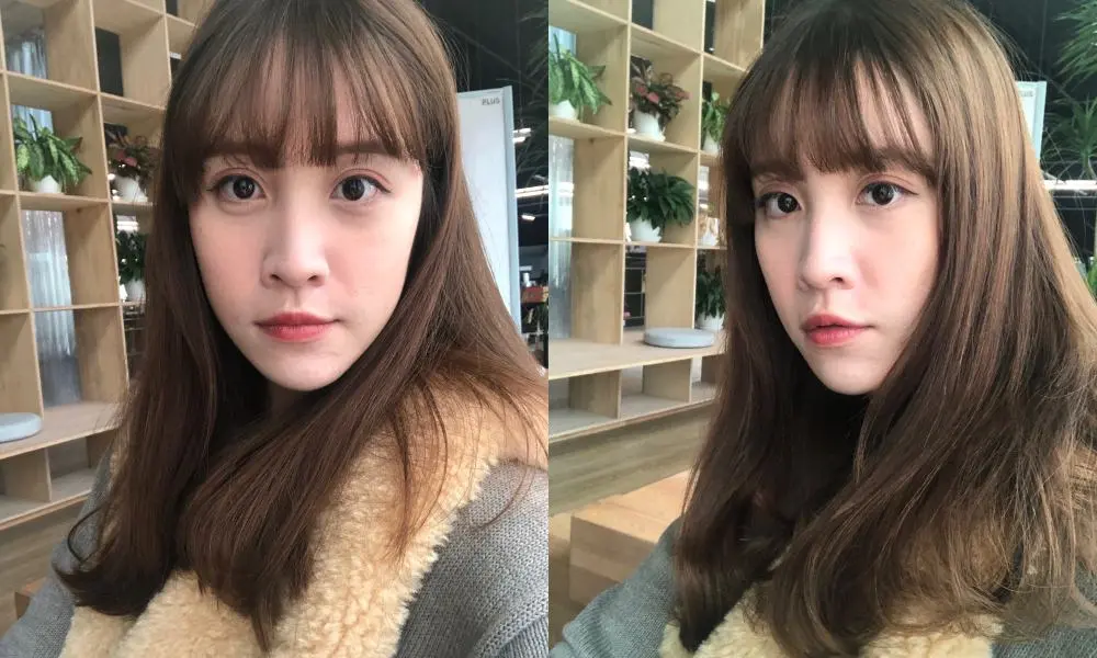 玻尿酸下巴術後下巴修飾完美