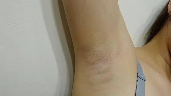 Miradry腋淨爽術後三天