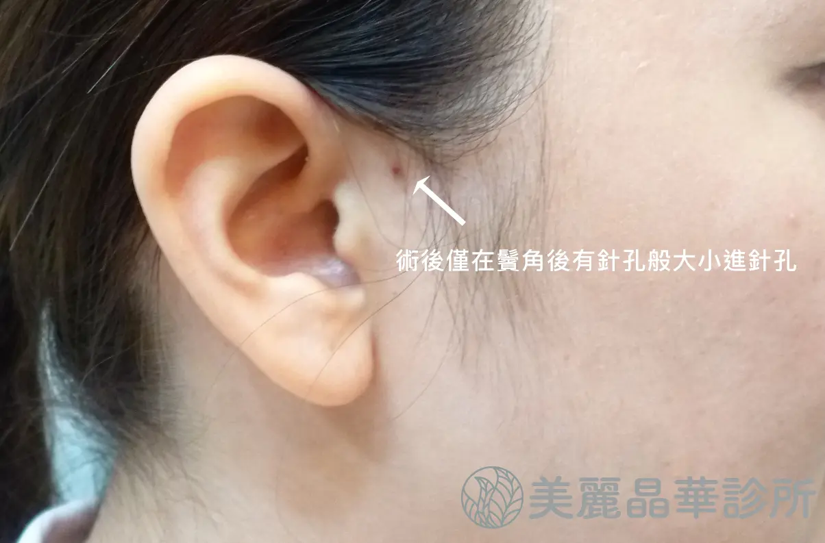埋線拉提進針孔極小