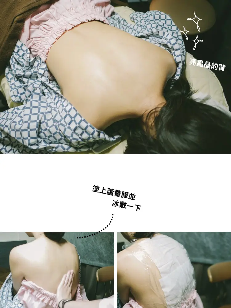 粉餅雷射美背治療後冰敷