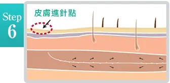 埋線拉提治療步驟6