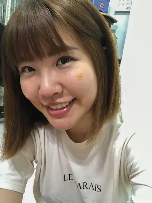 玻尿酸法令紋淚溝術後