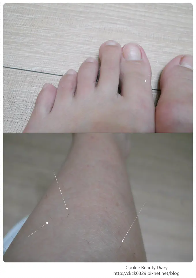 小腿雷射除毛治療前