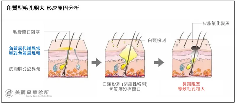 角質型毛孔粗大形成原因分析