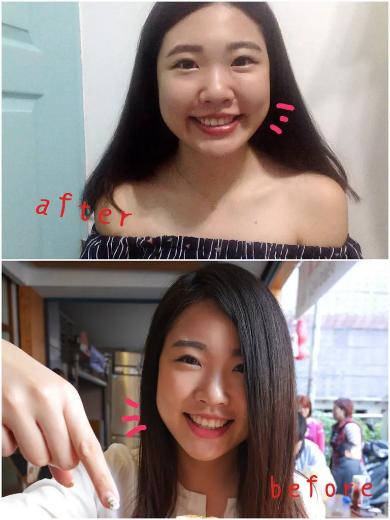 肉毒瘦小臉術前術後差異比對