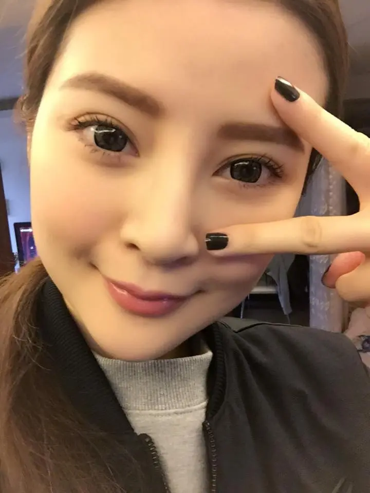 玻尿酸山根術後自然立體